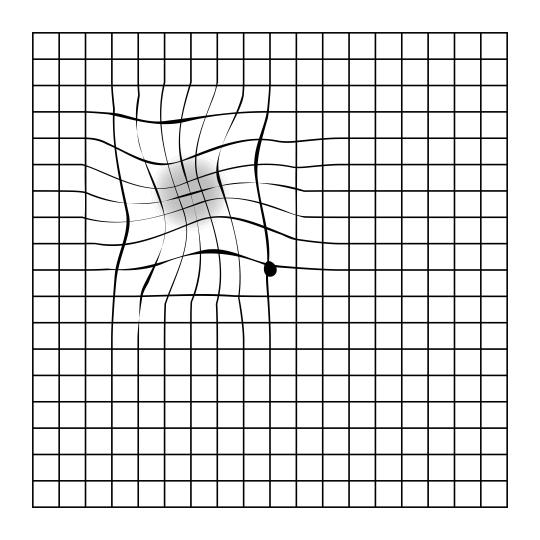 distored amsler grid lines