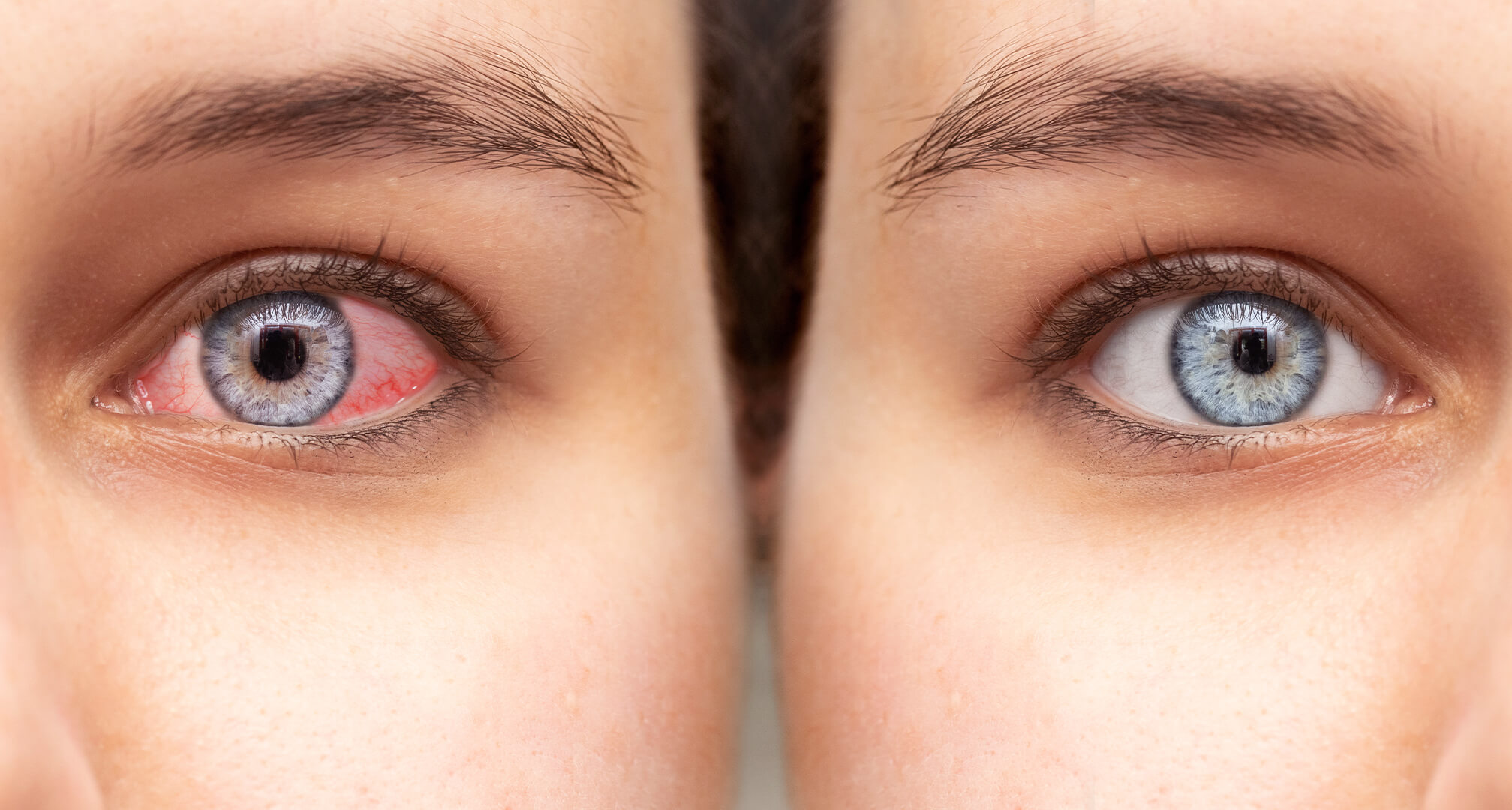 primer plano de dos ojos uno al lado del otro, un ojo rojo y seco a la izquierda y un ojo sano a la derecha