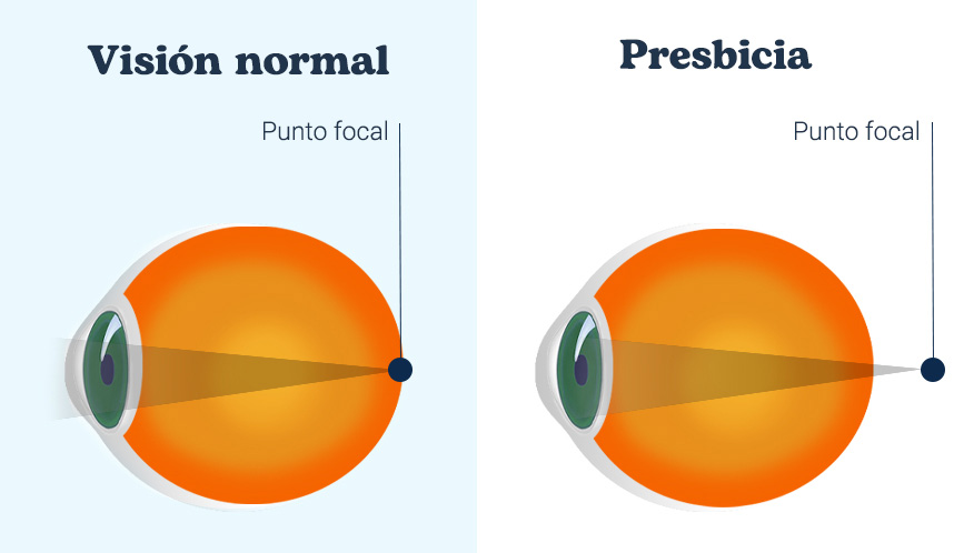 imagen del punto focal en ojo normal y en ojo con presbicia