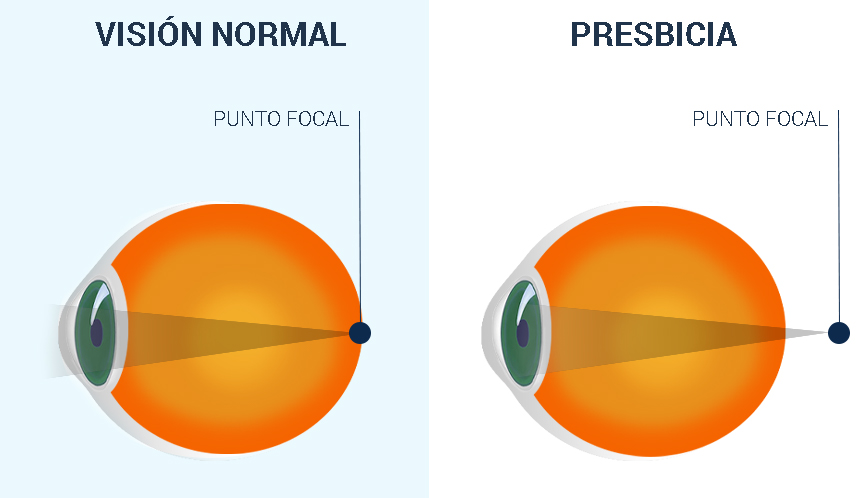 Presbyopia
