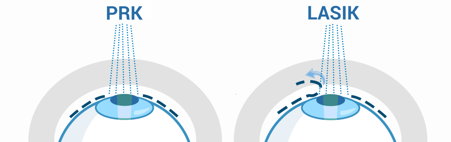LASIK vs. PRK